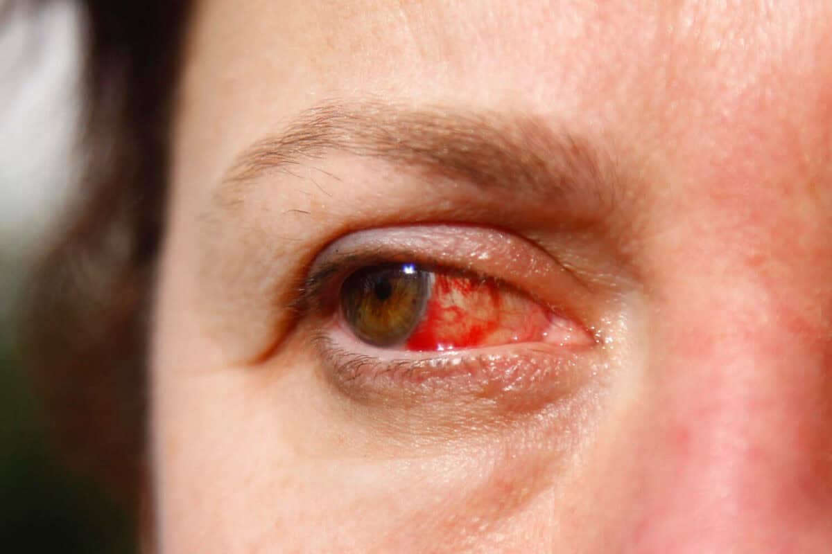 CBD כטיפול טבעי לדלקת עיניים